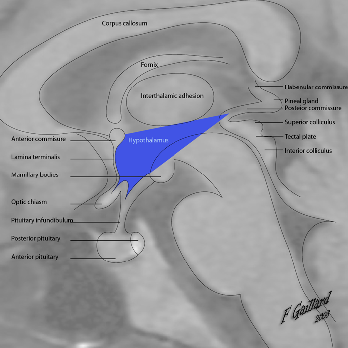 Radiopaedia Drawing Boundaries of the hypothalamus with translucent